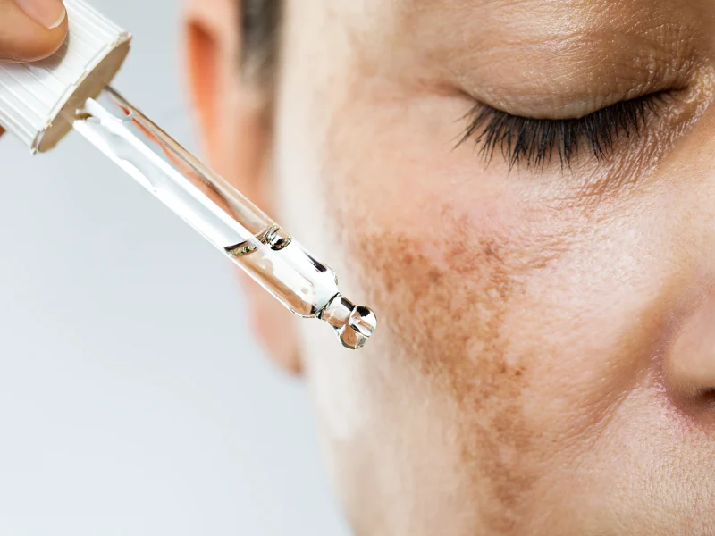 best-chemical-peel-for-dark-spots