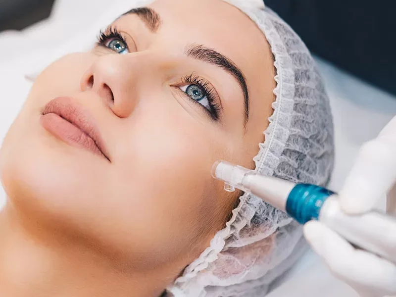 skin-prx-needling-2-1